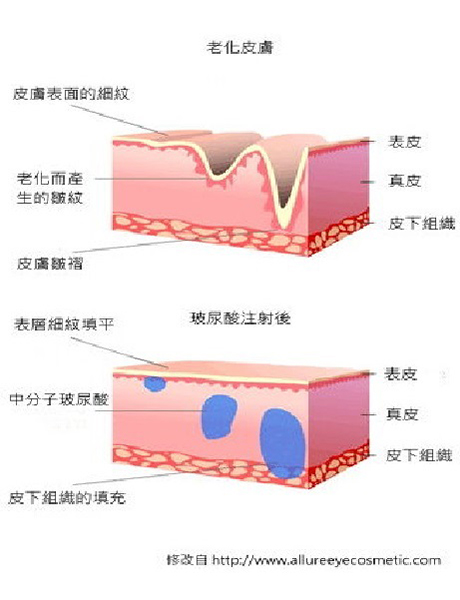 玻尿酸