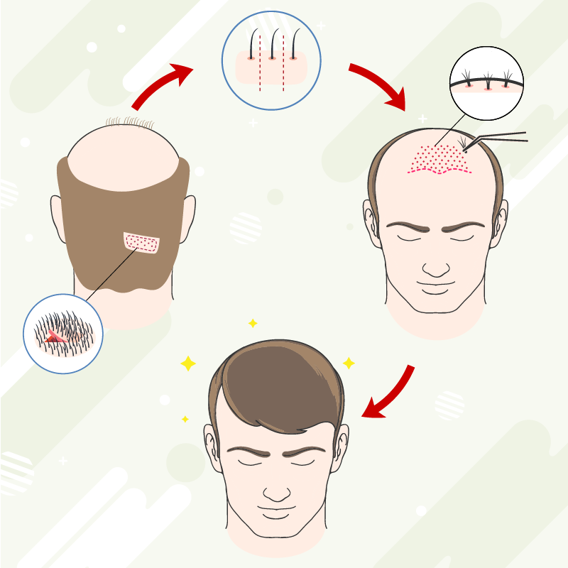 植髮手術的原理