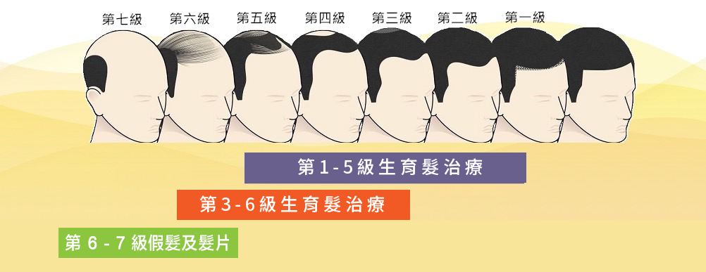 雄性禿分期1-7階段