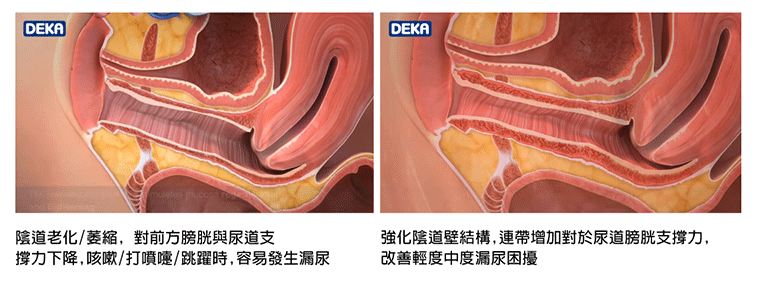 產後祕密處理